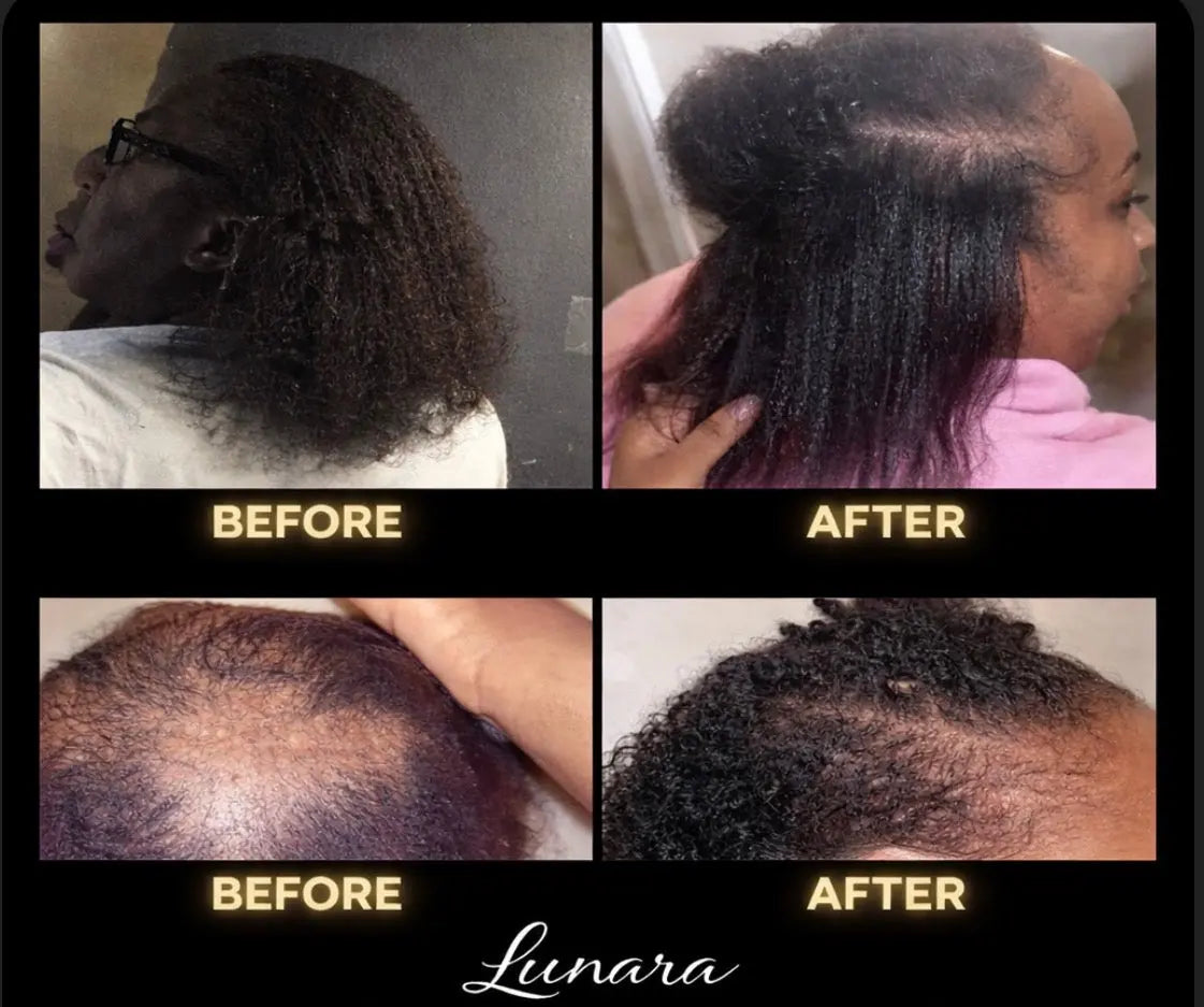 Lunara Crown Revivalβ’
Advanced Hair Growth Elixir ππππππ