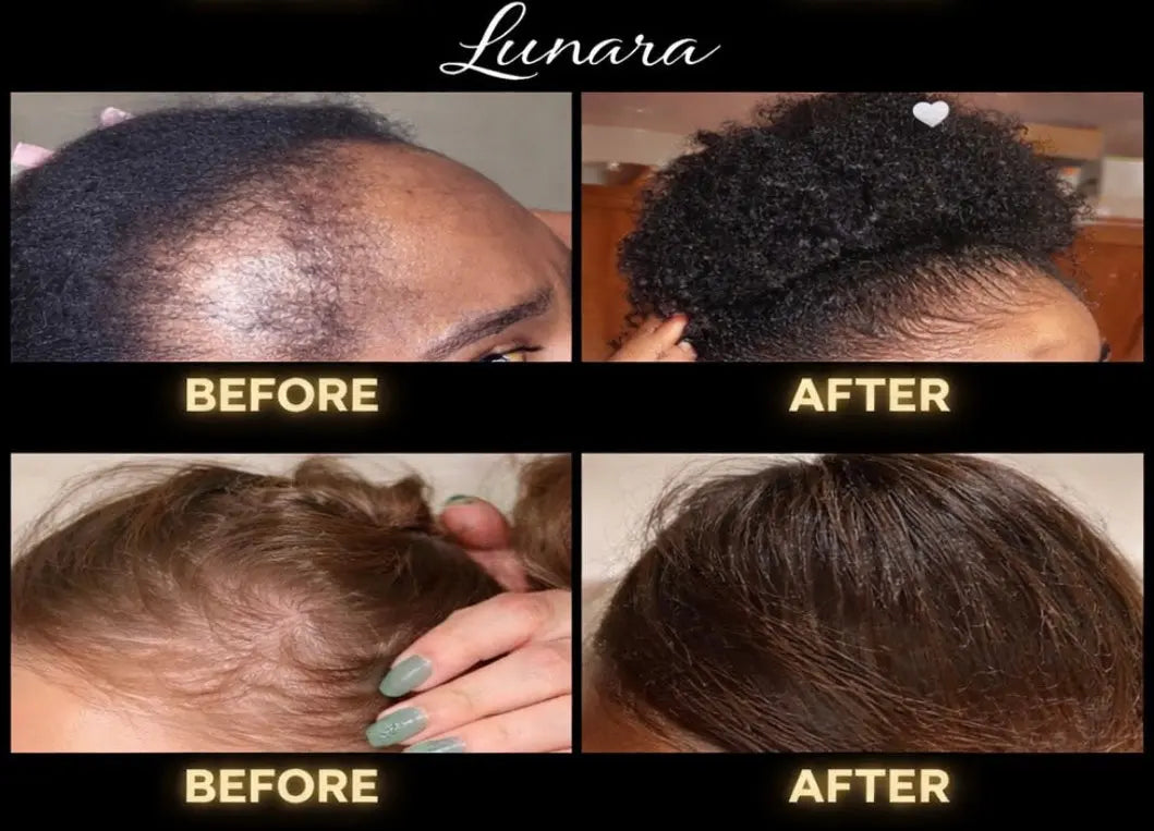 Lunara Crown Revival™
Advanced Hair Growth Elixir 𝒍𝒖𝒏𝒂𝒓𝒂